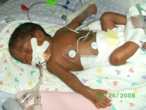Jalyn - 22 Days - Early Intervention Success Story Jalyn - 22 Days - Early Intervention Success Story